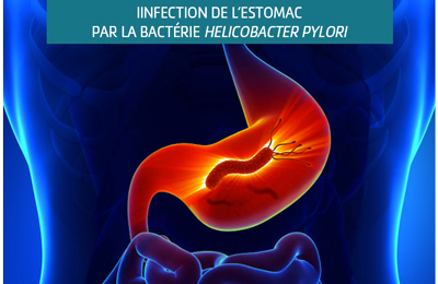 Infection de l'estomac par la bactérie HELICOBACTER PYLORI